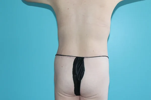 Body Contouring After Major Weight Loss