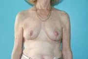 Breast Lift
