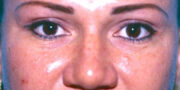 Eyelid Surgery