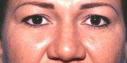 Eyelid Surgery