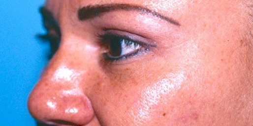 Eyelid Surgery