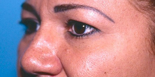 Eyelid Surgery