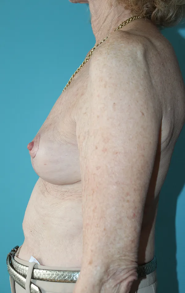Breast Lift