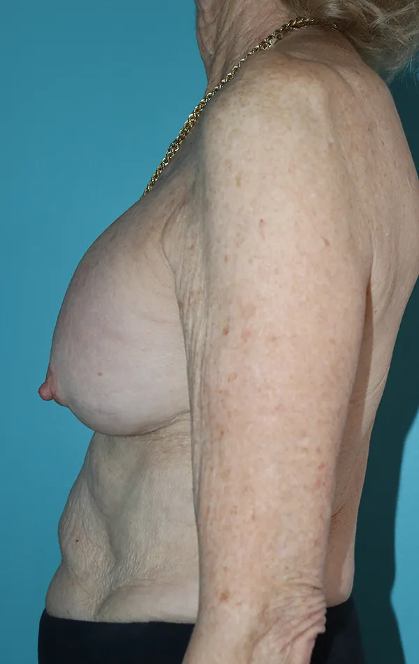Breast Lift