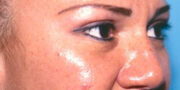 Eyelid Surgery