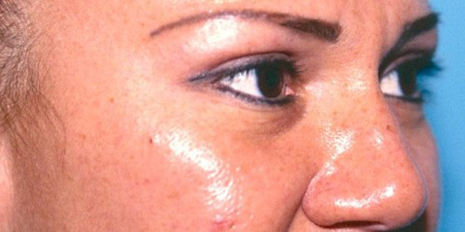 Eyelid Surgery