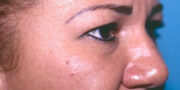 Eyelid Surgery