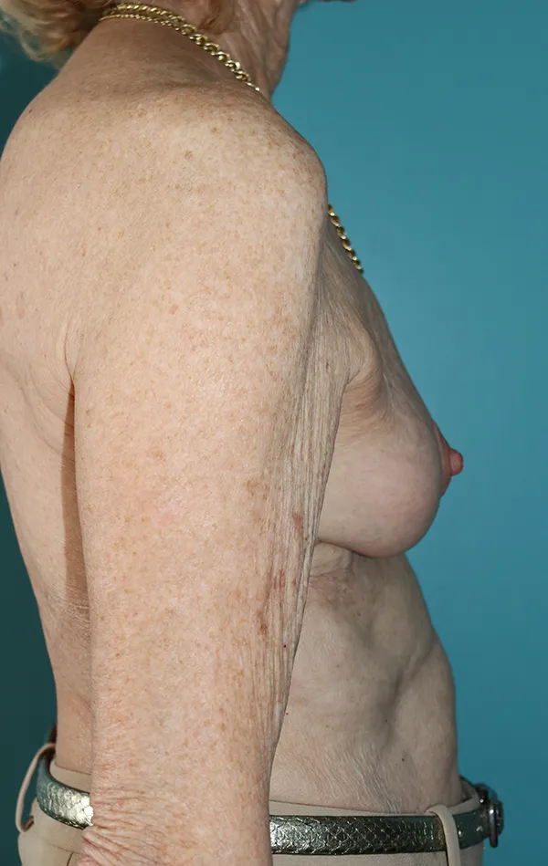 Breast Lift