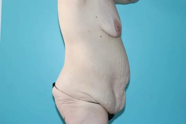 Body Contouring After Major Weight Loss