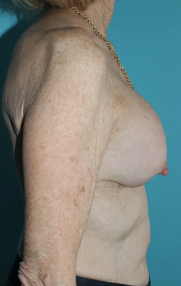 Breast Lift