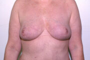 Breast Lift