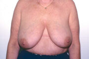 Breast Lift