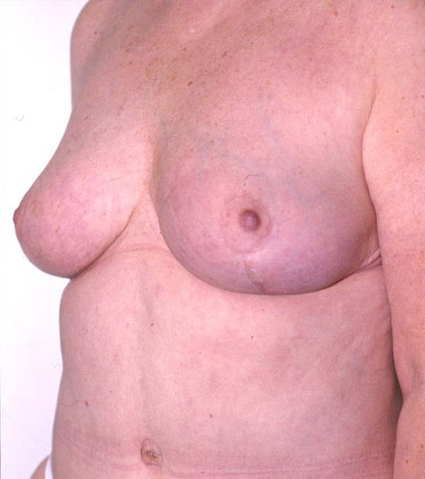 Breast Lift