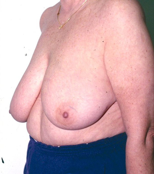 Breast Lift
