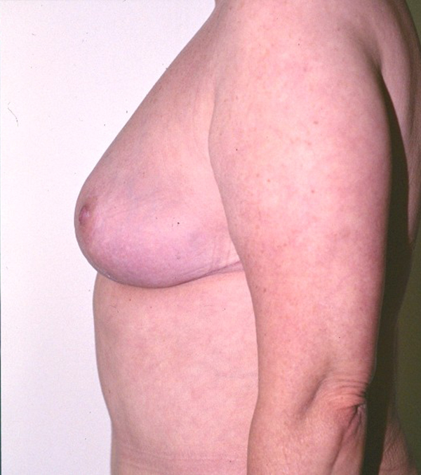 Breast Lift