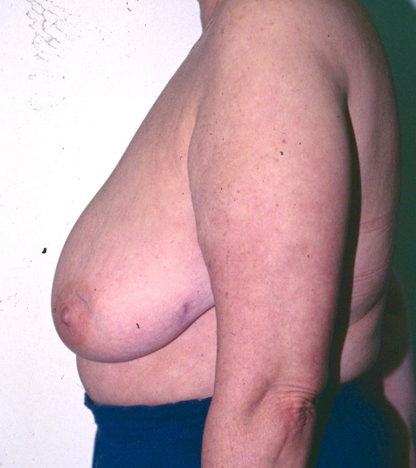 Breast Lift