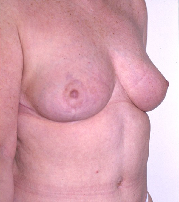 Breast Lift