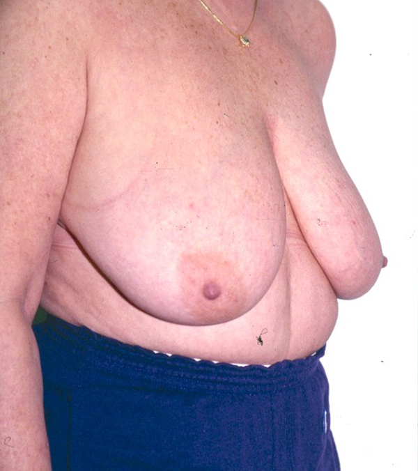 Breast Lift