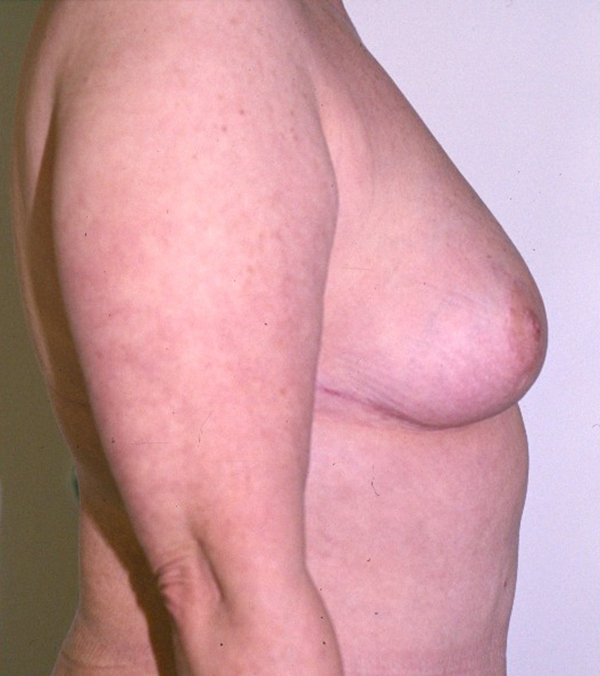 Breast Lift