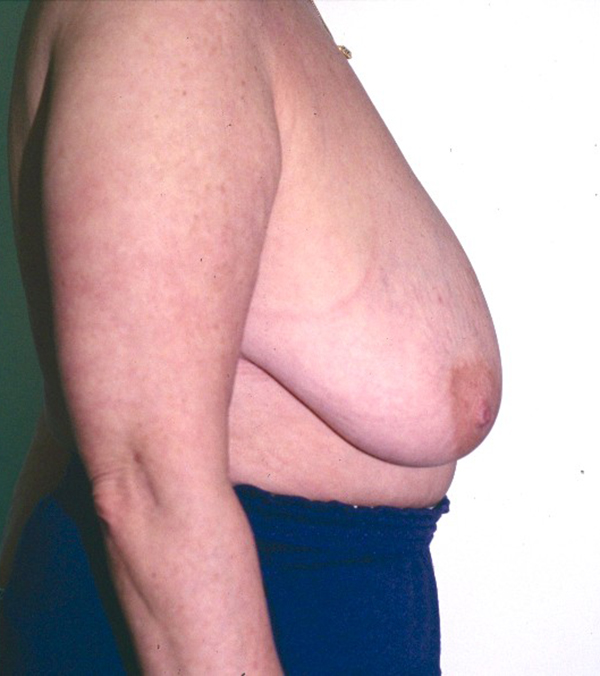 Breast Lift