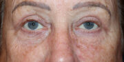 Eyelid Surgery