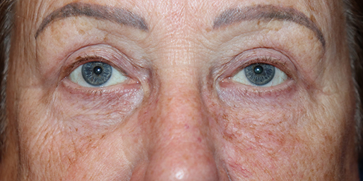 Eyelid Surgery