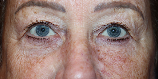 Eyelid Surgery