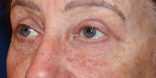 Eyelid Surgery