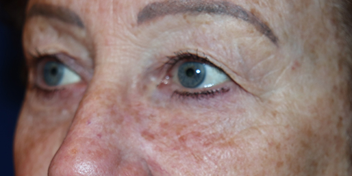 Eyelid Surgery