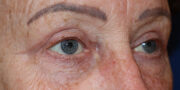 Eyelid Surgery