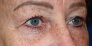 Eyelid Surgery