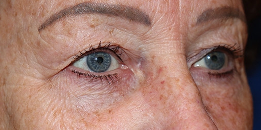 Eyelid Surgery